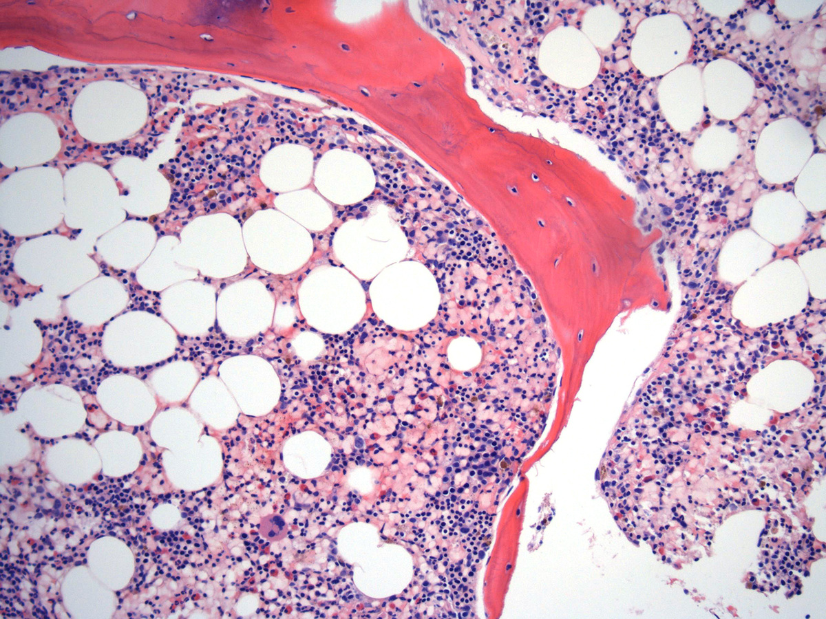 Bone Marrow biopsy_2
